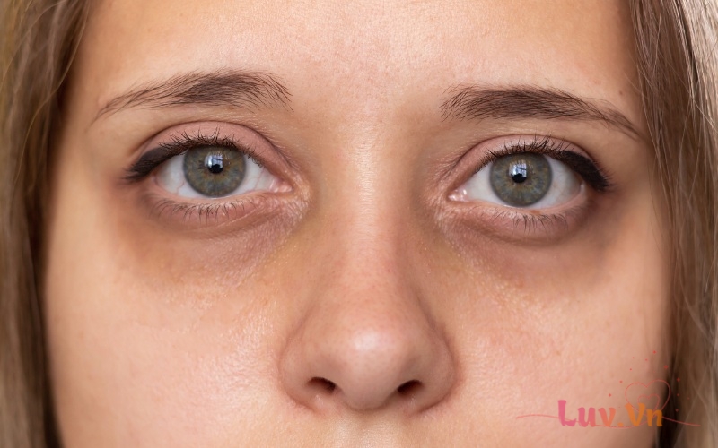 Tiêm HA trị thâm quầng mắt giúp cải thiện sắc tố vùng da dưới mắt hiệu quả