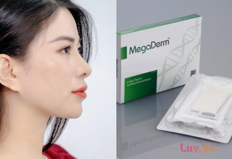 Giá nâng mũi bọc megaderm bao nhiêu? Có nên nâng mũi bọc megaderm? 7 Nâng mũi bọc sụn Megaderm khắc phục tình trạng da mũi mỏng, bị bóng đỏ dễ lộ sóng