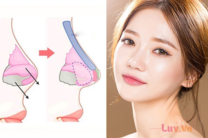 Giá nâng mũi bọc megaderm bao nhiêu? Có nên nâng mũi bọc megaderm? 8 Sụn Megaderm tương thích cơ thể và tạo ra dáng mũi hài hào tỷ lệ khuôn mặt
