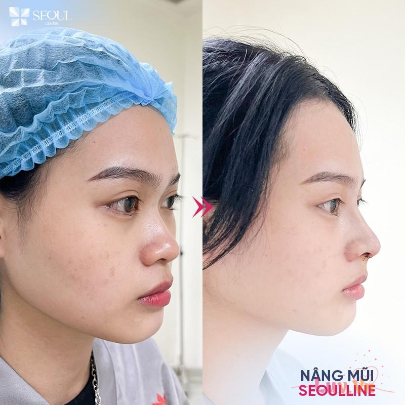 Giá nâng mũi bọc megaderm bao nhiêu? Có nên nâng mũi bọc megaderm? 9 Nâng mũi bọc Megaderm có mức giá khoảng 30 - 60 triệu đồng
