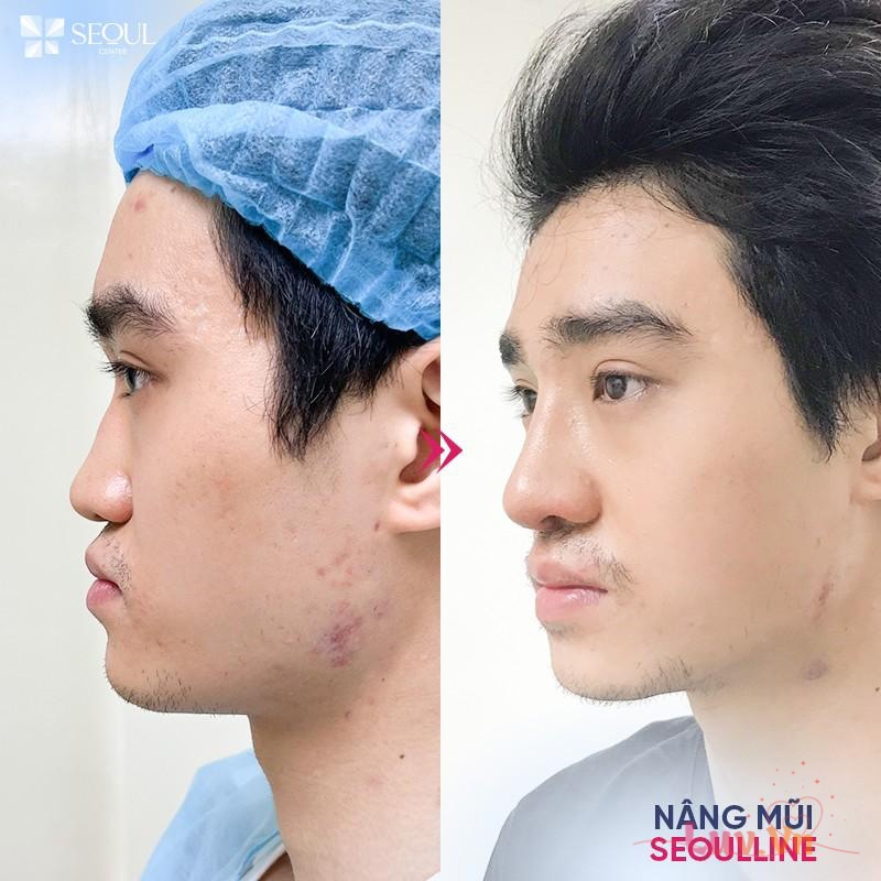 Giá nâng mũi bọc megaderm bao nhiêu? Có nên nâng mũi bọc megaderm? 10 Nâng mũi bọc Megaderm hạn chế xâm lấn, giúp dáng mũi có độ cong mềm mại và đảm bảo an toàn